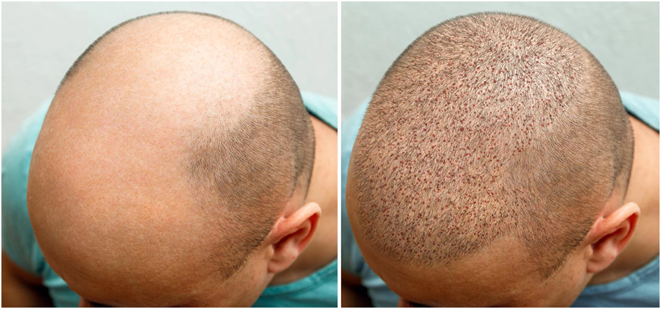 What Is the Best Hair Transplant Method?