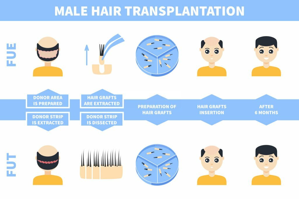 Everything You Need to Know About Hair Transplant from Procedure to Recovery